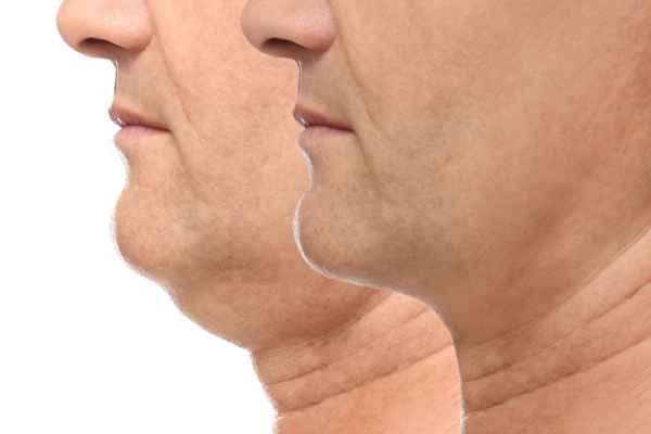 HIFU - Breakthrough in Anti - ageing 2 hifu results Port Glasgow