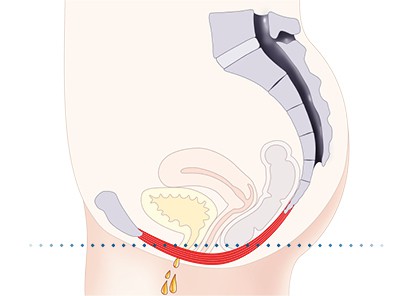 Pelvic-Floor Muscle Repair 5 Pelvic floor muscles Port Glasgow
