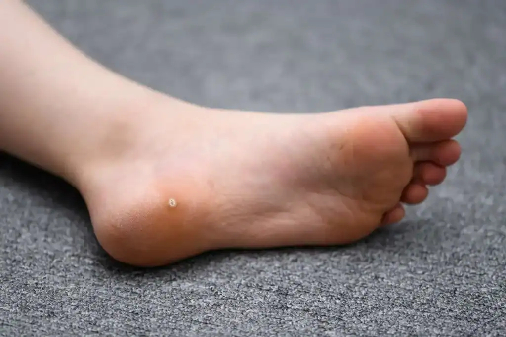 Cryotherapy For Warts And Also Verrucas 2 Image of verruca on the bottom of the foot that able to be treated with Cryotherapy Port Glasgow