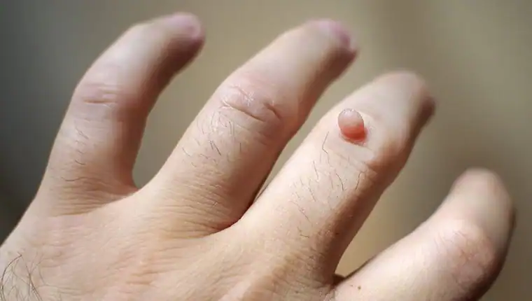 Cryotherapy For Warts And Also Verrucas 1 Image of blemish that Cryotherapy Port Glasgow can remove with Lipo 360.
