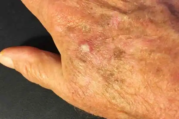 Cryopen For Actinic Keratoses 1 Image of Actinic keratoses Port Glasgow on a person hand